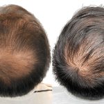 Hair Transplants Before & After Patient #769