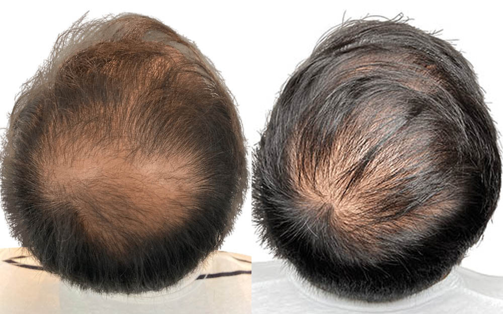 Hair Transplants Before & After Patient #769