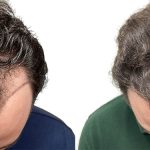 Hair Transplants Before & After Patient #773