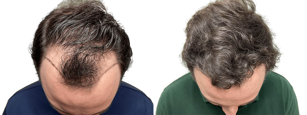 Hair Transplants Before & After Patient #773