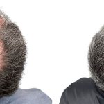 Hair Transplants Before & After Patient #778