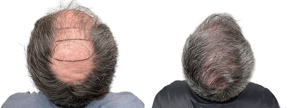 Hair Transplants Before & After Patient #778