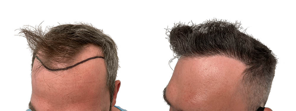 Hair Transplants Before & After Patient #782