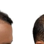 Hair Transplants Before & After Patient #786