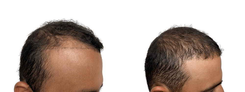 Hair Transplants Before & After Patient #786