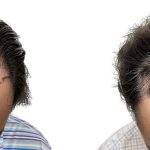 Hair Transplants Before & After Patient #790