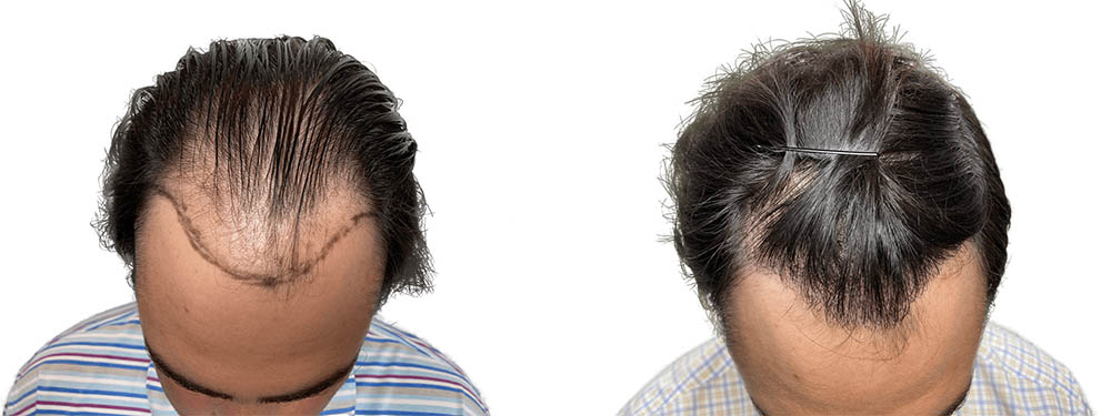 Hair Transplants Before & After Patient #790