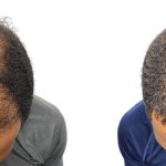 Hair Transplants Before & After Patient #661