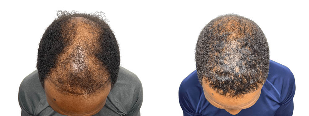 Hair Transplants Before & After Patient #661