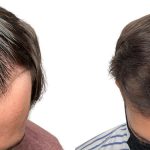 Hair Transplants Before & After Patient #666