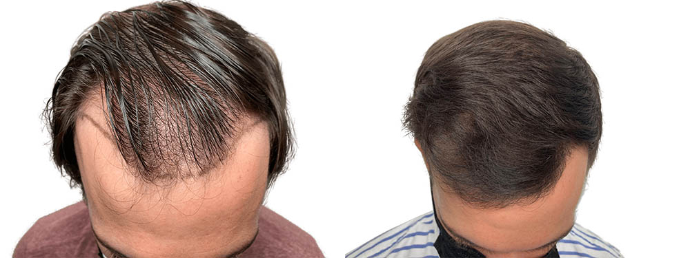 Hair Transplants Before & After Patient #666