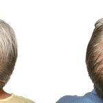 Hair Transplants Before & After Patient #667