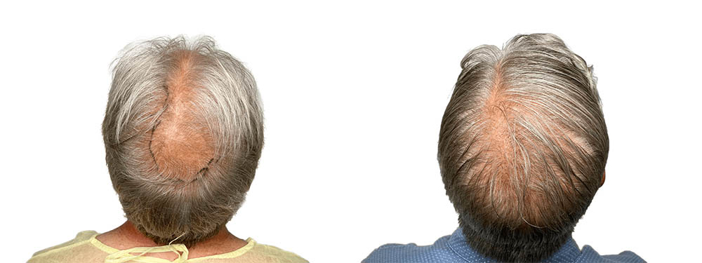 Hair Transplants Before & After Patient #667