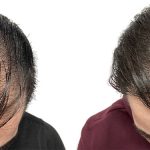 Hair Transplants Before & After Patient #687