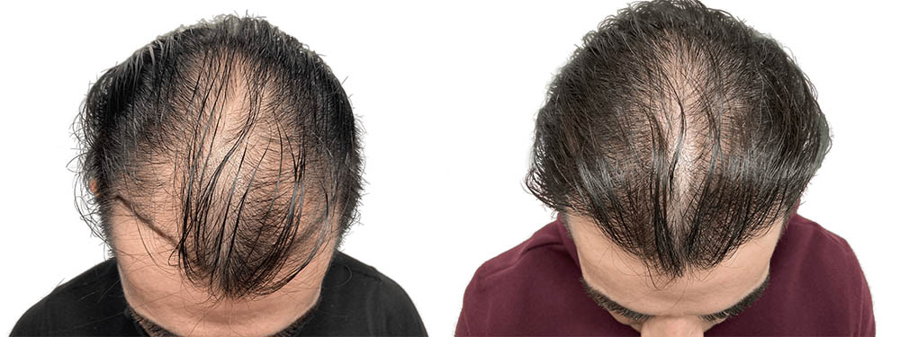 Hair Transplants Before & After Patient #687