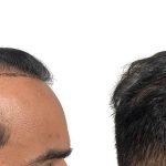 Hair Transplants Before & After Patient #704