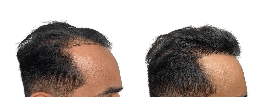 Hair Transplants Before & After Patient #704