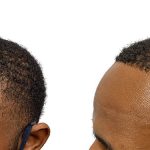 Hair Transplants Before & After Patient #709