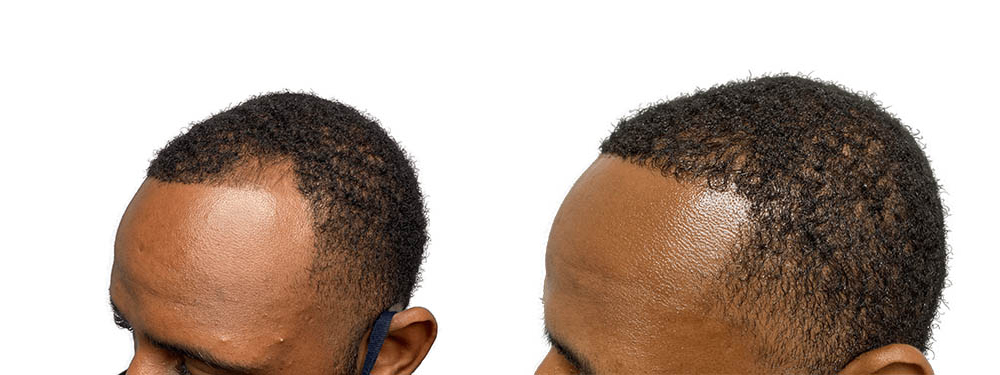 Hair Transplants Before & After Patient #709