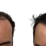 Hair Transplants Before & After Patient #714