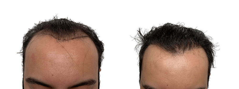 Hair Transplants Before & After Patient #714
