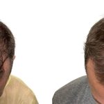 Hair Transplants Before & After Patient #719