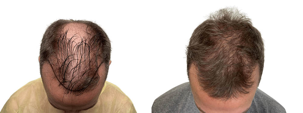 Hair Transplants Before & After Patient #719