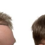 Hair Transplants Before & After Patient #723