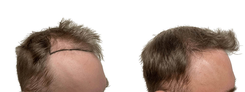 Hair Transplants Before & After Patient #723