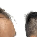 Hair Transplants Before & After Patient #728