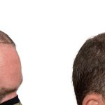 Hair Transplants Before & After Patient #733