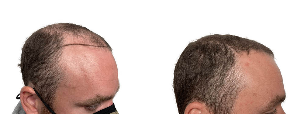 Hair Transplants Before & After Patient #733