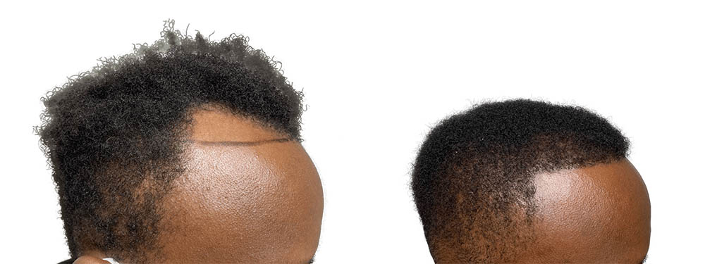 Hair Transplants Before & After Patient #738