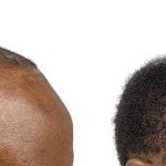 Hair Transplants Before & After Patient #743