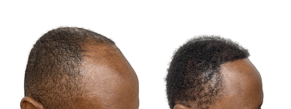 Hair Transplants Before & After Patient #743