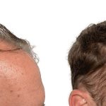 Hair Transplants Before & After Patient #748