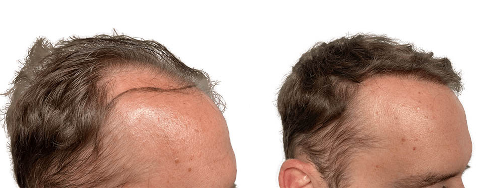 Hair Transplants Before & After Patient #748