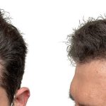 Hair Transplants Before & After Patient #753