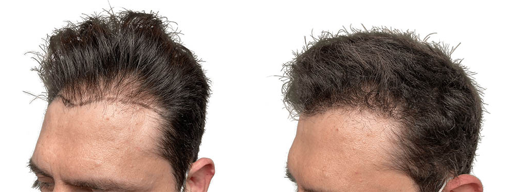 Hair Transplants Before & After Patient #753