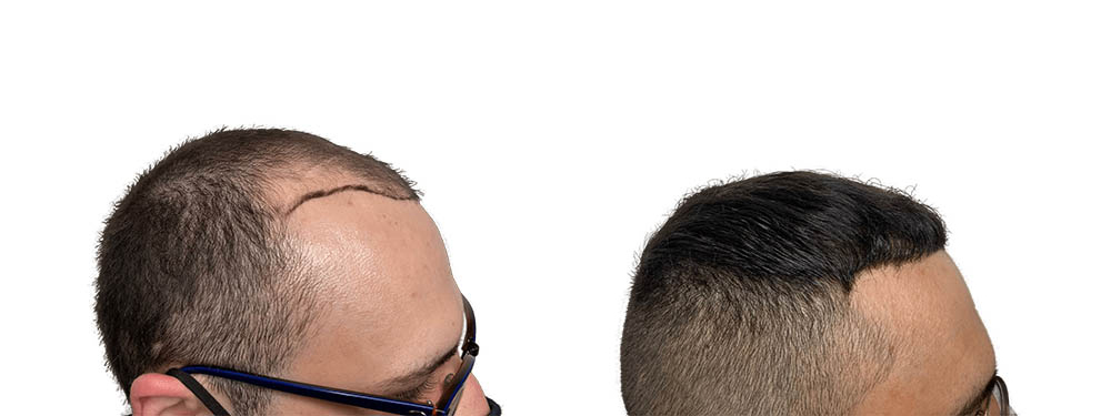 Hair Transplants Before & After Patient #757