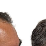 Hair Transplants Before & After Patient #762