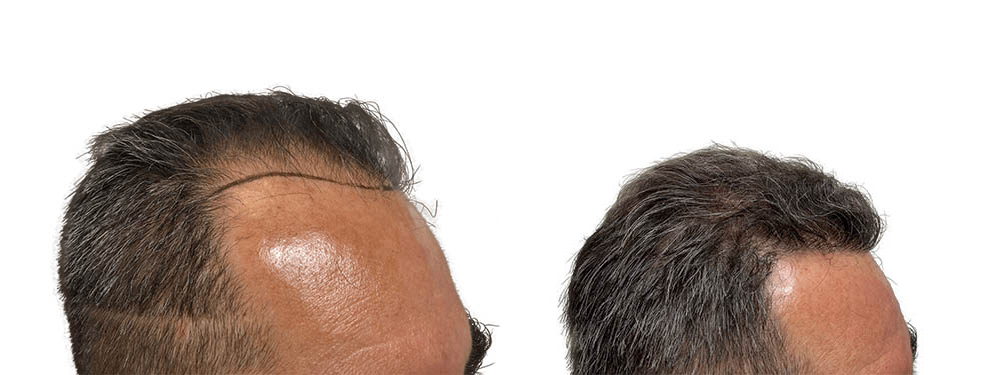 Hair Transplants Before & After Patient #762