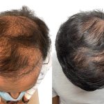 Hair Transplants Before & After Patient #769