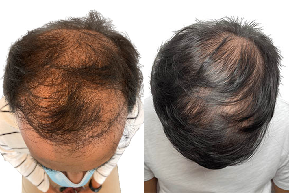 Hair Transplants Before & After Patient #769