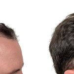 Hair Transplants Before & After Patient #773