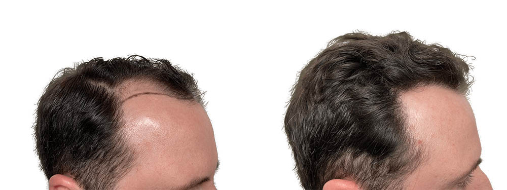 Hair Transplants Before & After Patient #773