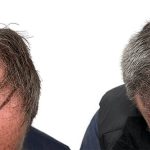 Hair Transplants Before & After Patient #778