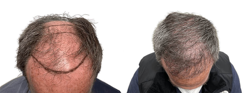 Hair Transplants Before & After Patient #778