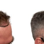 Hair Transplants Before & After Patient #782