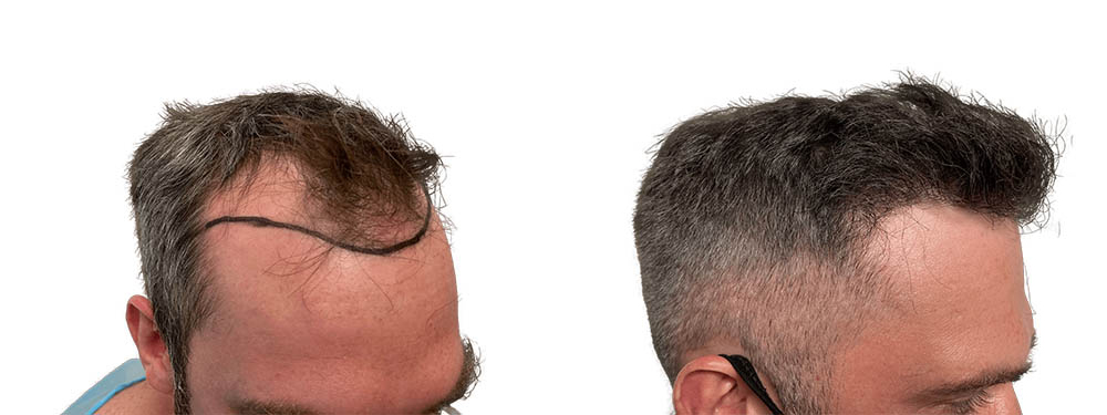 Hair Transplants Before & After Patient #782